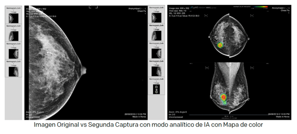 Mamografías